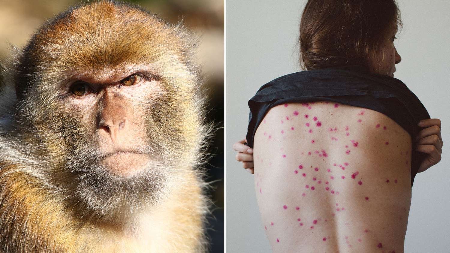 Viruela del mono: qué es, cómo se transmite y cuáles son sus síntomas